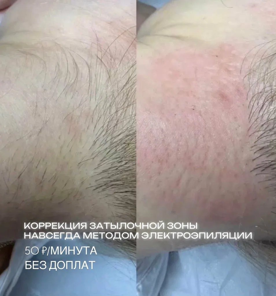 Электроэпиляция — фото 3
