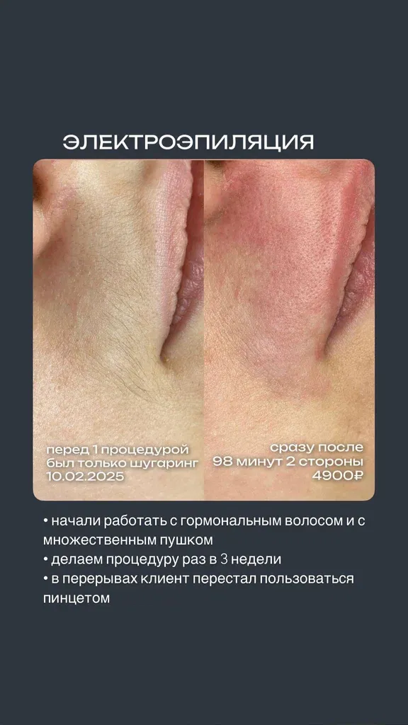 Электроэпиляция — фото 4