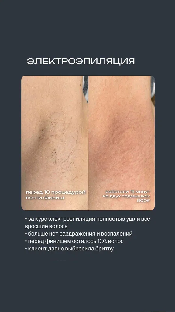 Электроэпиляция — фото 5