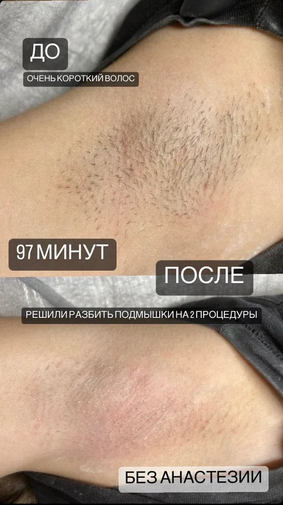 Электроэпиляция — фото 6