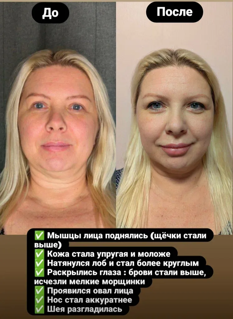 Витапластика — фото 1