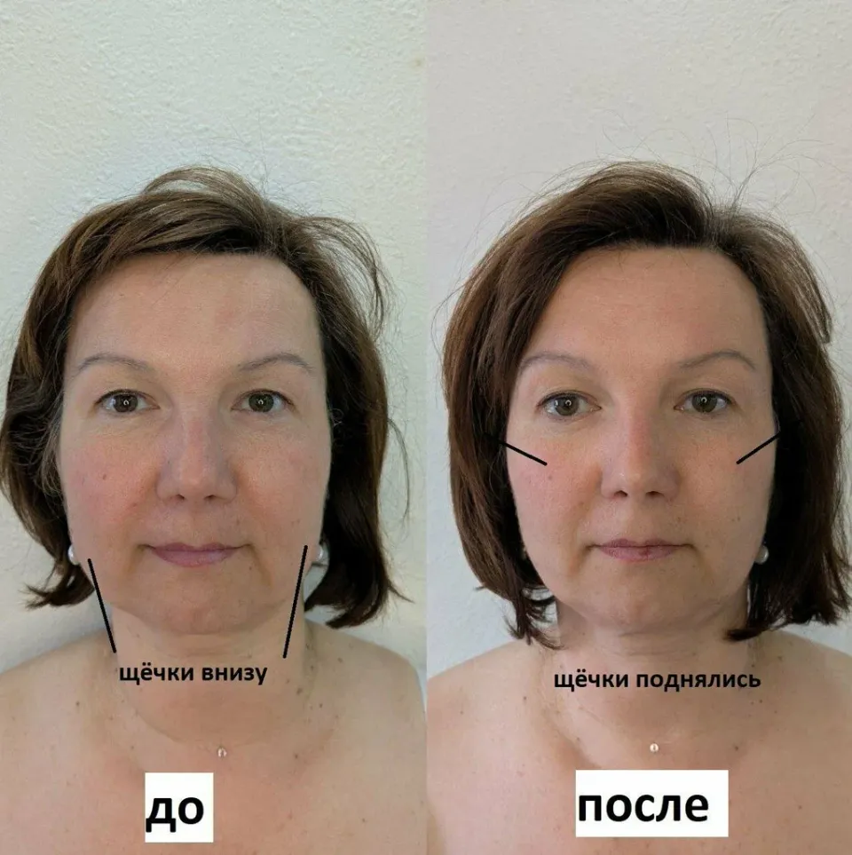 Витапластика — фото 4