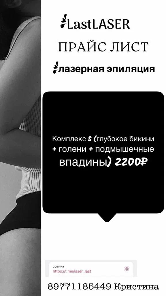 Лазерная эпиляция — фото 4