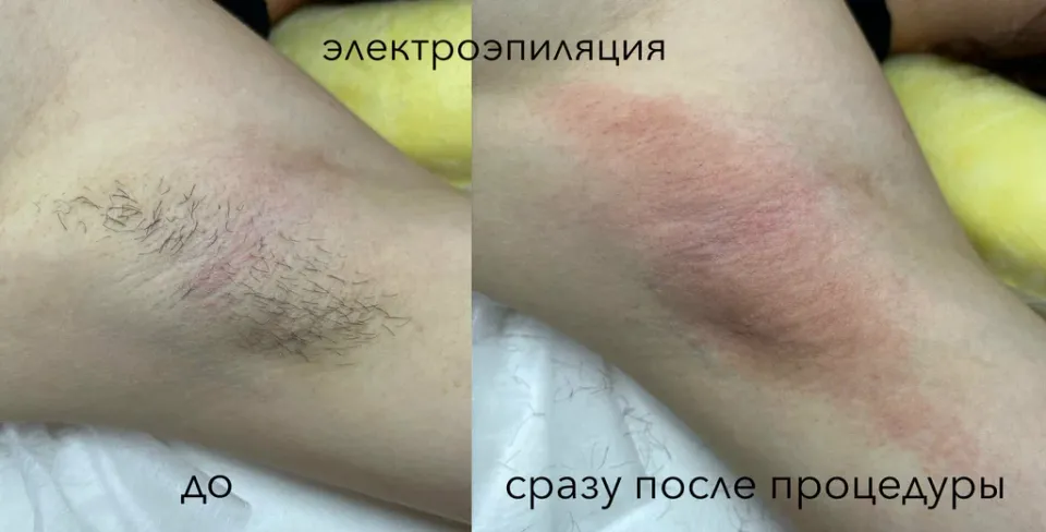 Студия электропиляции Антипиной Анны — фото 6