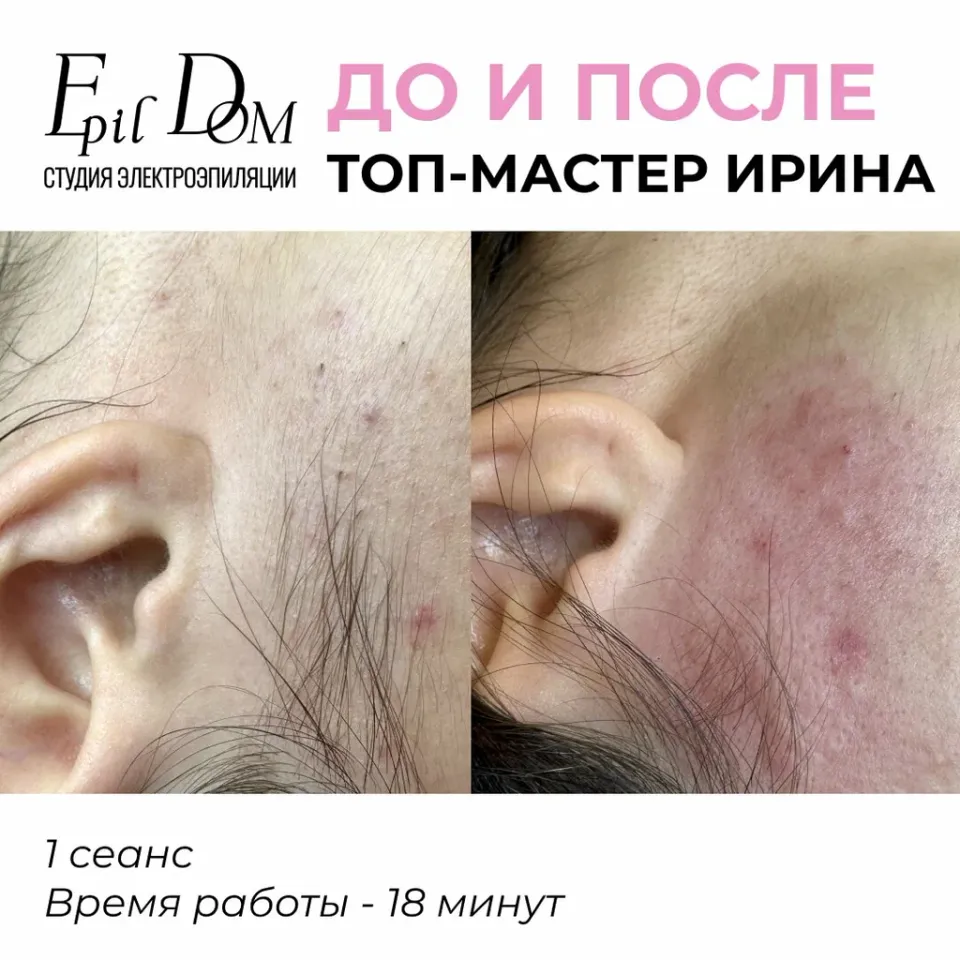 Электроэпиляция — фото 5