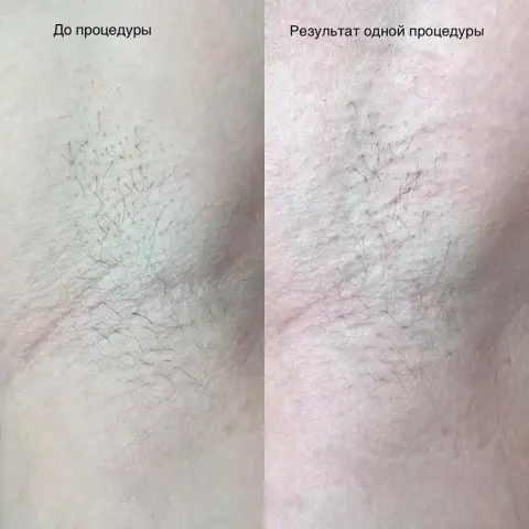 Электроэпиляция