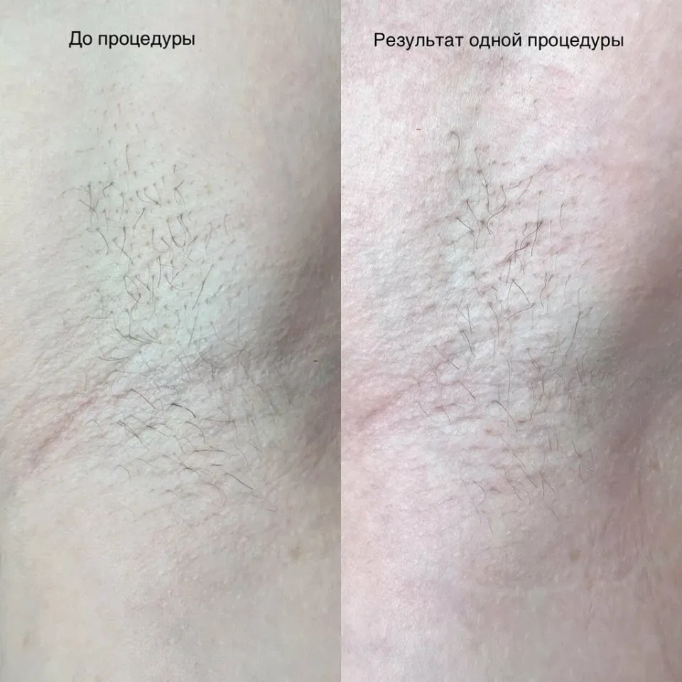 Электроэпиляция — фото 1