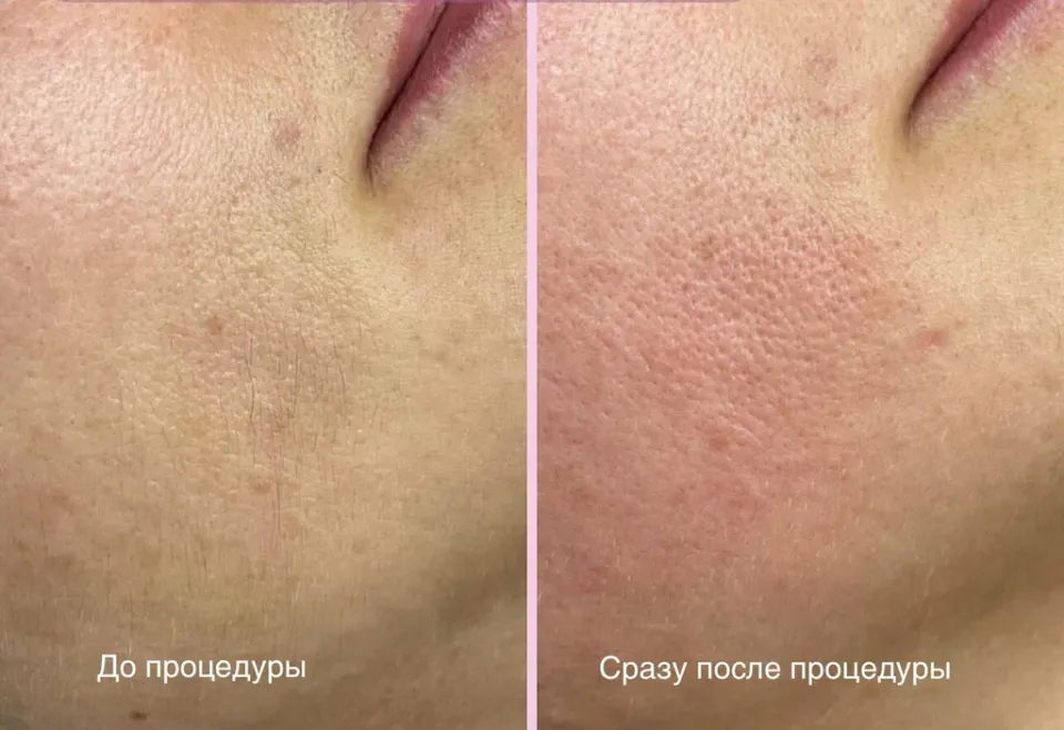 Электроэпиляция — фото 6